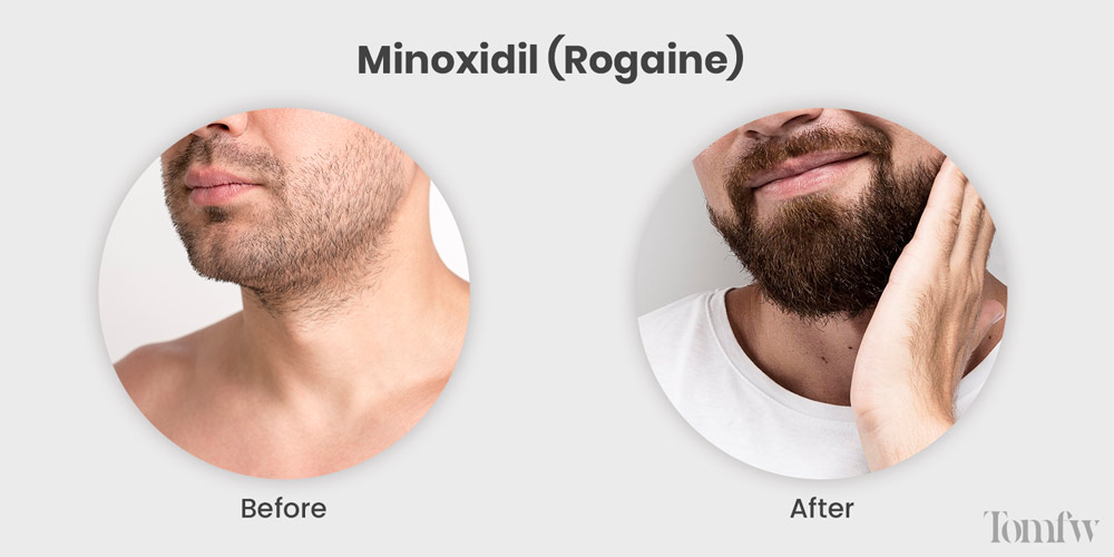Minoxidil For Beard Growth And Minoxidil Beard Before And After